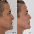 Side-by-side Glory Cream comparison of a person's face before and after a procedure on Day 1 and Day 7.