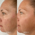 Before and after comparison of a woman's face with visible skin improvement over 4 weeks.