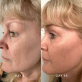 Before and after comparison of a woman's face with visible skin texture changes over 14 days.